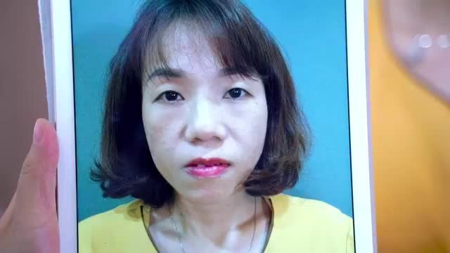 Thổi hồn vào đôi mắt sụp mí u buồn già nua trở nên tươi trẻ rạng rỡ chỉ sau 45 phút thực hiện tiểu phẫu Cắt mí mk