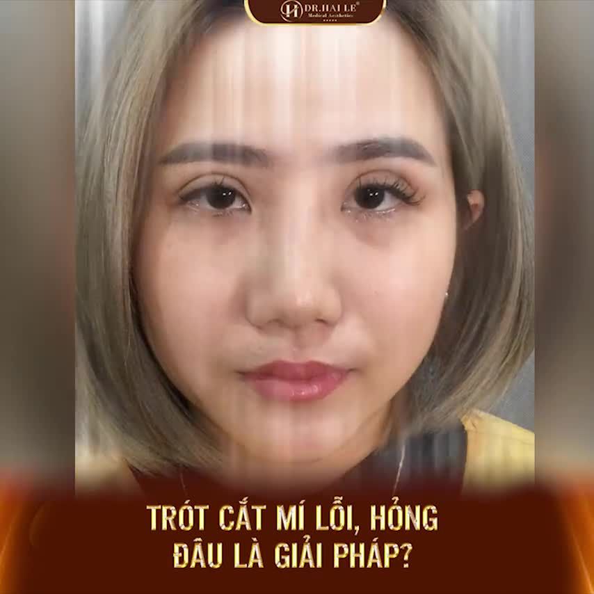 Trót cắt mí bị lỗi, hỏng và lời khuyên thật tâm dành cho các chị em