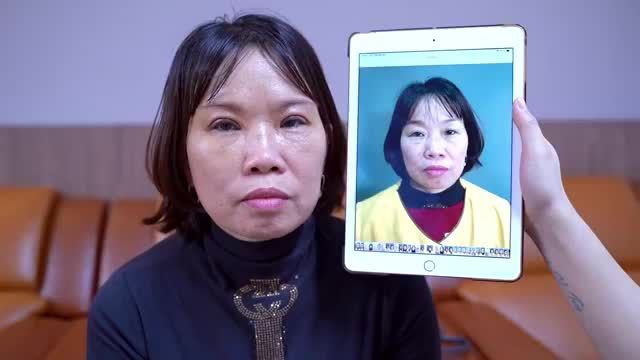 Cùng theo dõi combo cắt mí nâng cung mày sau 1 tuần tại Dr.Hải Lê