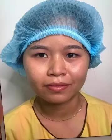 Kết quả cắt mí mk giải quyết hết tình trạng da mí mắt dày chùng sụp mí tại chi nhánh TP.HCM