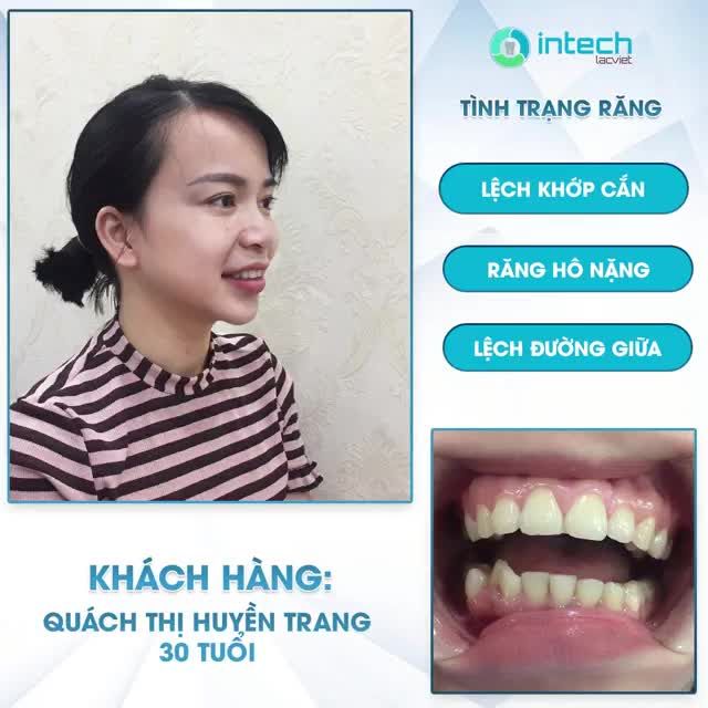 CẢI THIỆN RĂNG HÔ VỚI PHƯƠNG PHÁP NIỀNG RĂNG MẮC CÀI SỨ