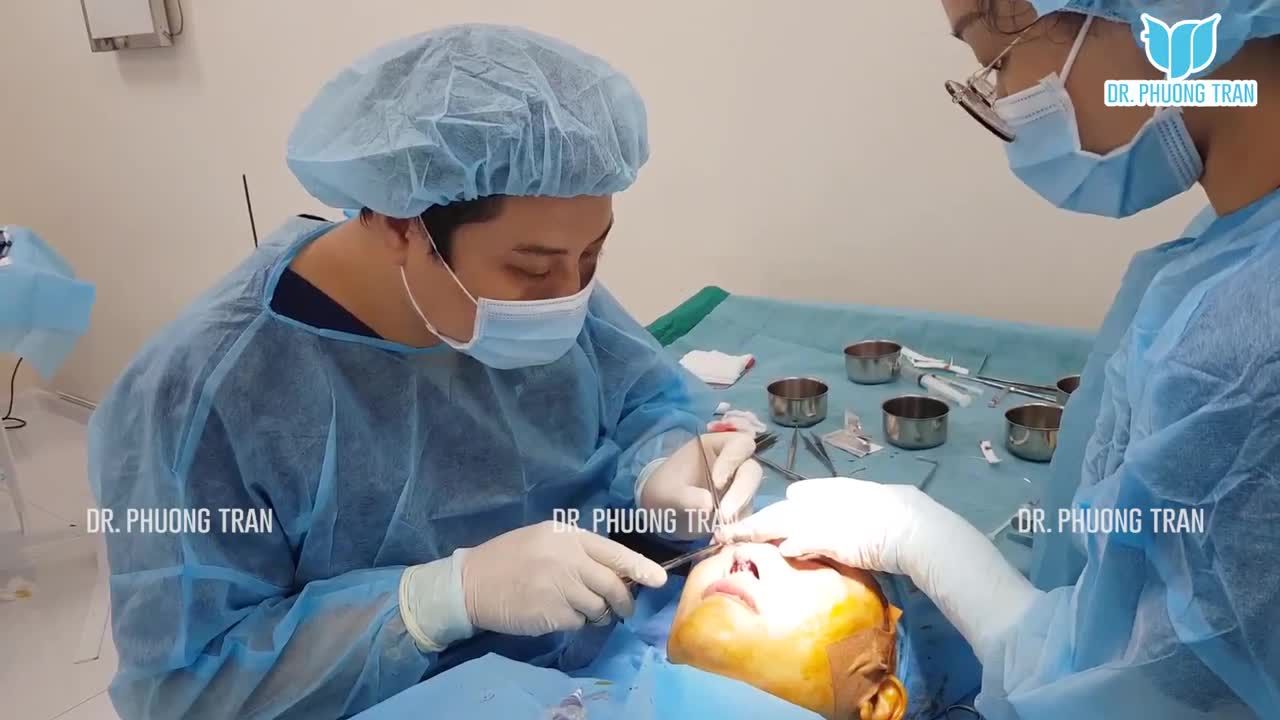 Gần 2 giờ thực hiện Combo Nâng mũi Lấy mỡ mí mắt dưới kết quả ra sao?