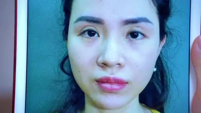 MẮT LỖI HỎNG DO THỰC HIỆN TẠI CƠ SỞ KHÔNG UY TÍN DẪN ĐẾN BIẾN CHỨNG PHẢI KHẮC PHỤC NHƯ THẾ NÀO?
