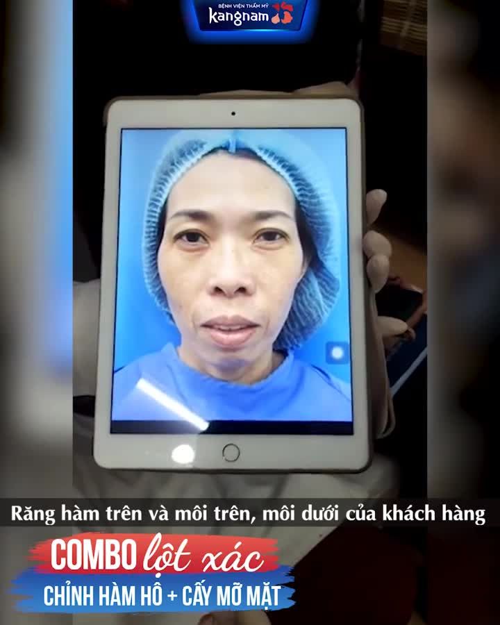 CHỈNH HÀM HÔ CẤY MỠ Lột Xác ngỡ ngàng!