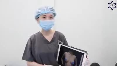 CẤY MỠ TỰ THÂN SAU KHI ĐẶT TÚI NGỰC CÓ ẢNH HƯỞNG ĐẾN KẾT QUẢ THẨM MỸ NGỰC KHÔNG??
