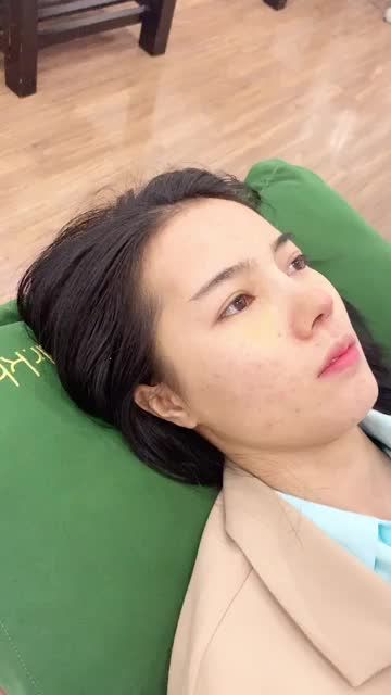 MŨI ĐẸP NGỠ NGÀNG SAU 10 NGÀY PHẪU THUẬT