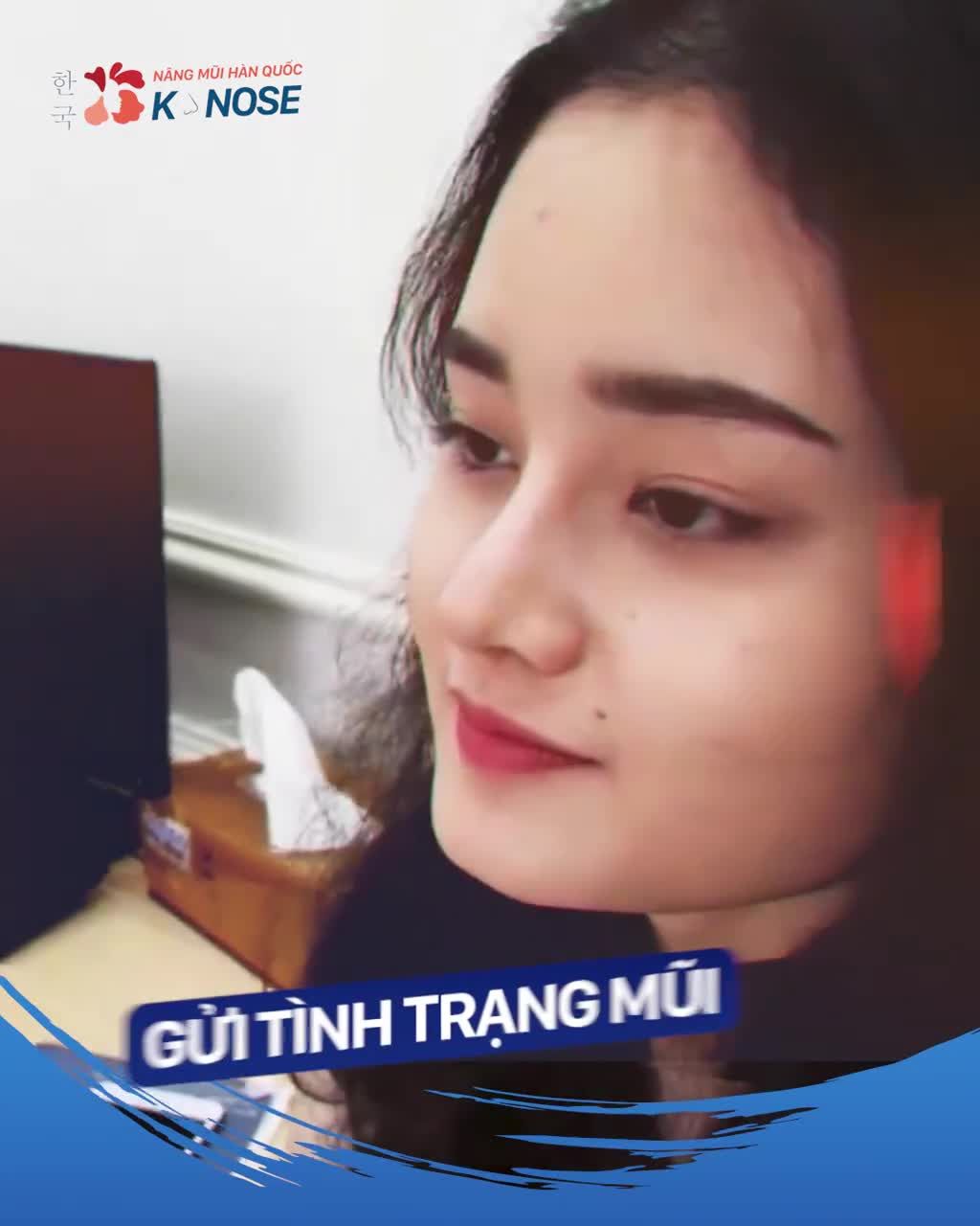Muốn nâng mũi dáng "bay", Sline tự nhiên! Chọn công nghệ gì?