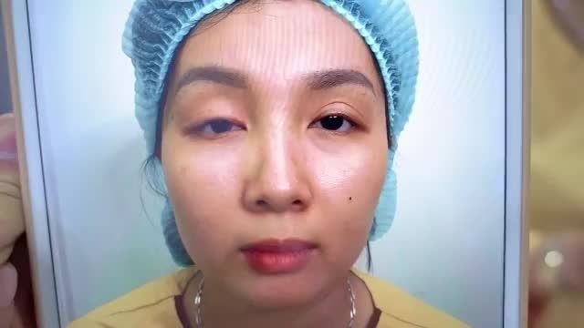 Sụp mí bẩm sinh  chỉnh hình mí nhiều lần không thành công khắc phục như thế nào tại Dr.Hải Lê? Mời quý khách hàng cùng theo dõi video trực tiếp sau đây