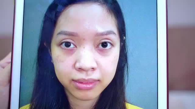 Mí xấu, hỏng, lỗi Dr.Hải Lê dều có thể GIẢI CỨU thành công nhờ kỹ thuật Sửa mí Deep Tech20. BẤM XEM NGAY!