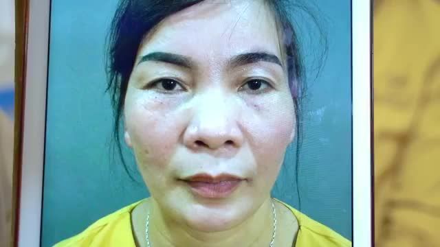 Khắc phục sụp mí, da chảy xệ với bí kíp cực hay. Nâng cung mày Dr.Hải Lê chưa bao giờ khiến chị em thất vọng!