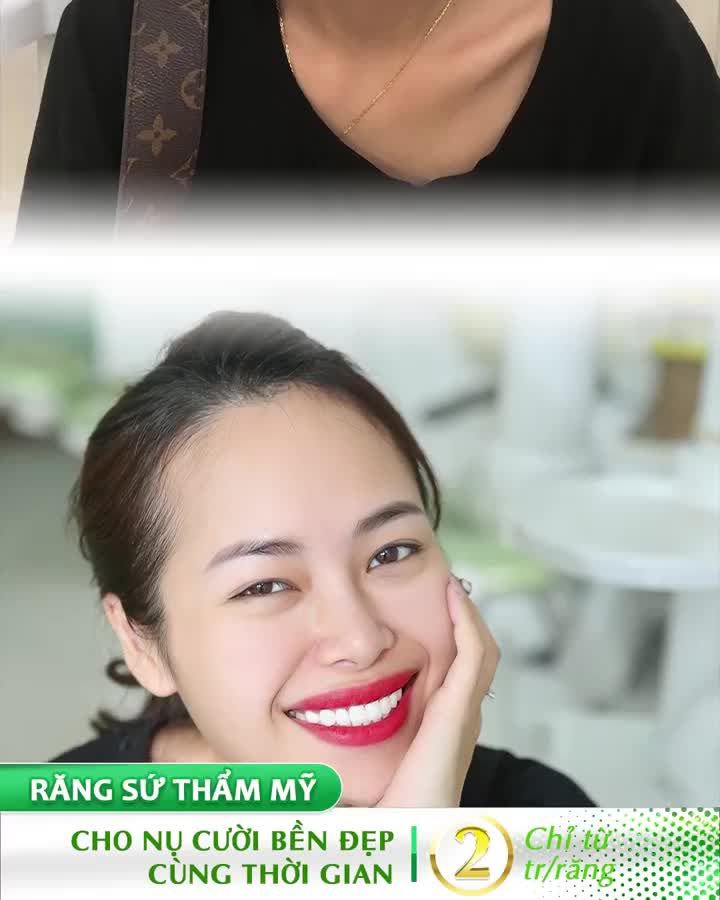 THAY ĐỔI NỤ CƯỜI MỘT CÁCH NGOẠN MỤC CHỈ SAU 2 LẦN HẸN
