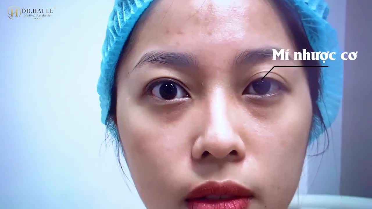 Trước khi quyết định cắt mí từng đắn đo suy nghĩ rất lâu: Chưa tìm được bác sĩ ưng ý Không biết làm xong liệu có đẹp không