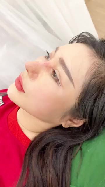 Dáng mũi cấu trúc sau 10 ngày