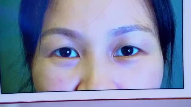 Nâng cung mày giải quyết những khuyết điểm nào từ đôi mắt sụp mí u buồn già nua? Mời bạn đón xem để có câu trả lời và có thêm động lực