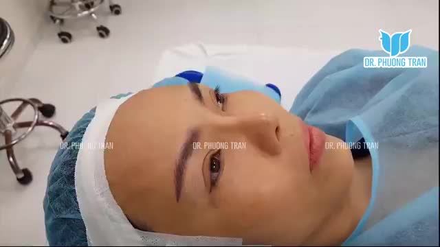 NÂNG MŨI BẰNG CHẤT LIỆU SILICONE CÓ NHỮNG ƯU VÀ NHƯỢC ĐIỂM GÌ?