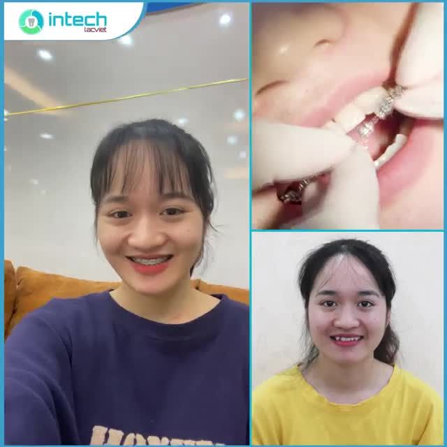 HÓA HOT GIRL VÀO GIÂY PHÚT THÁO MẮC CÀI