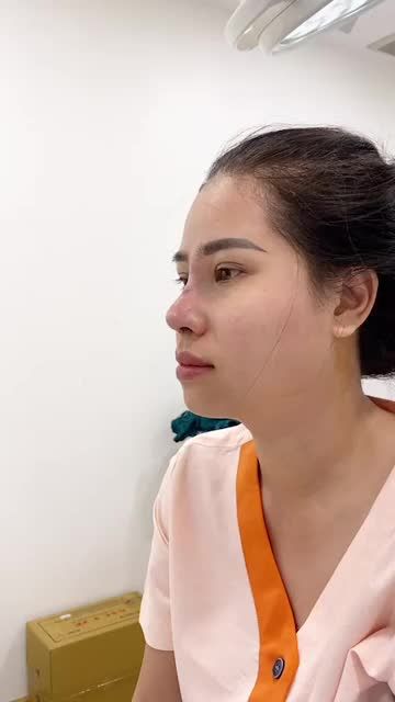 Khắc phục 100% khuyết điểm mũi cũ