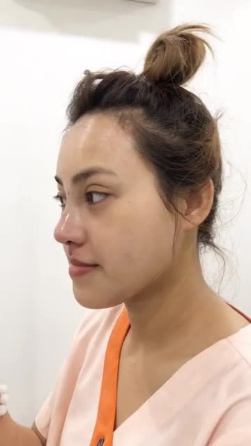 Khách hàng nâng mũi cấu trúc sụn tai