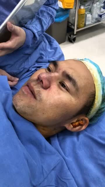 SỐC với kết quả trước sau nâng mũi K Nose anh khách hàng