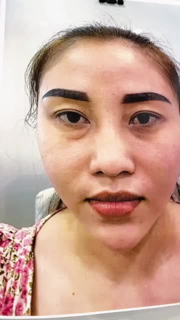 Ca nâng mũi cấu trúc cho khách hàng từng tiêm filler
