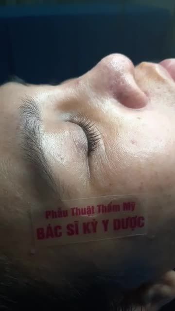 Livetream trực tiếp Khách Hàng tái khám MŨI ĐẸP THANH TÚ BS KỲ Y DƯỢC