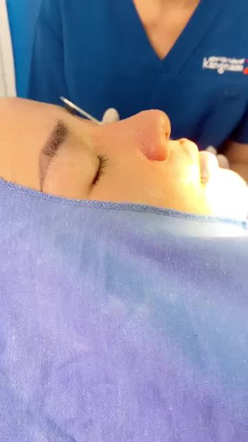 LO SỢ mũi sau nâng xuất hiện bóng đỏ, lộ sụn, sẹo xấu?