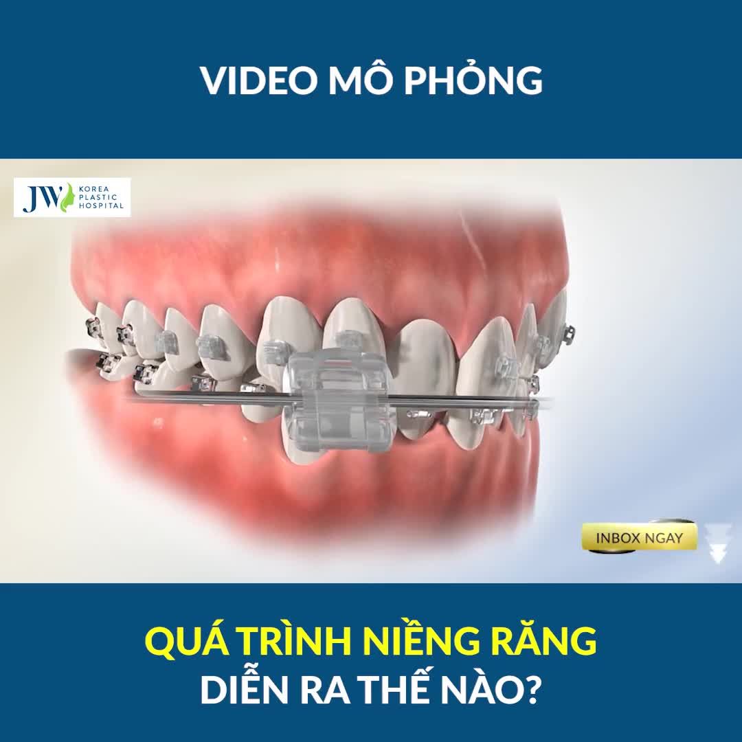 RĂNG ĐỀU RĂNG ĐẸP AI CŨNG MÊ