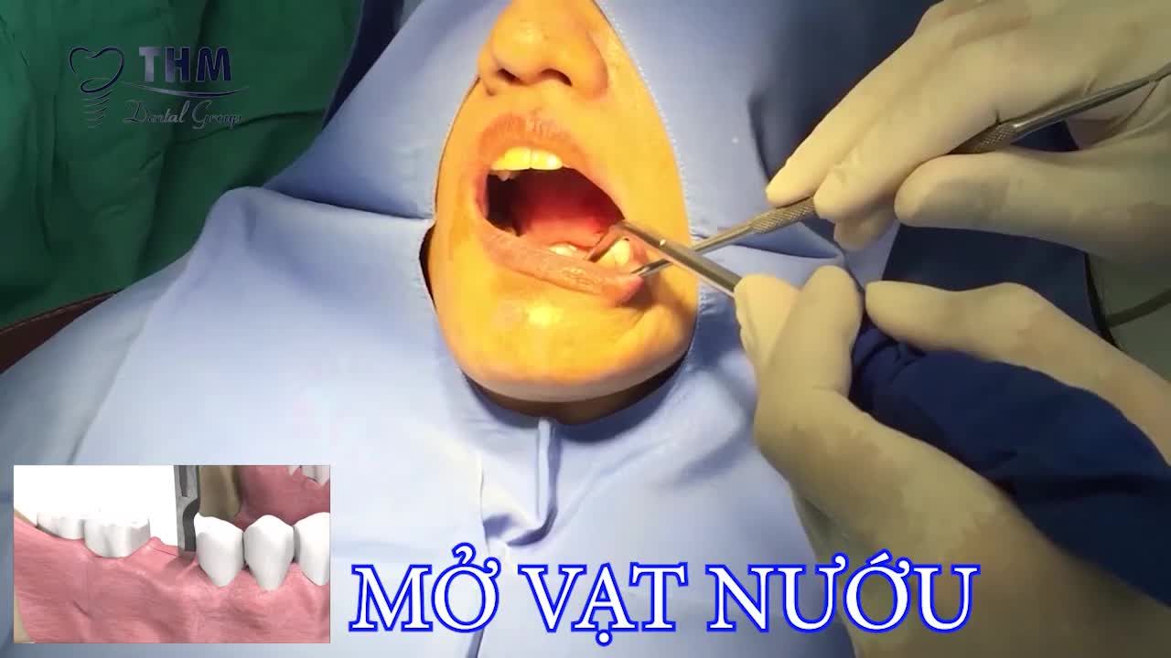 7 LÝ DO LỰA CHỌN TRỒNG RĂNG IMPLANT TẠI NHA KHOA THẾ HỆ MỚI