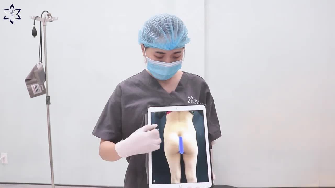 KẾT QUẢ THỰC TẾ MÔNG SAU KHI NÂNG VÀ BẬT MÍ ĐIỀU CHỈNH DÁNG NGỒI SAU NÂNG MÔNG NHƯ THẾ NÀO LÀ ĐÚNG?