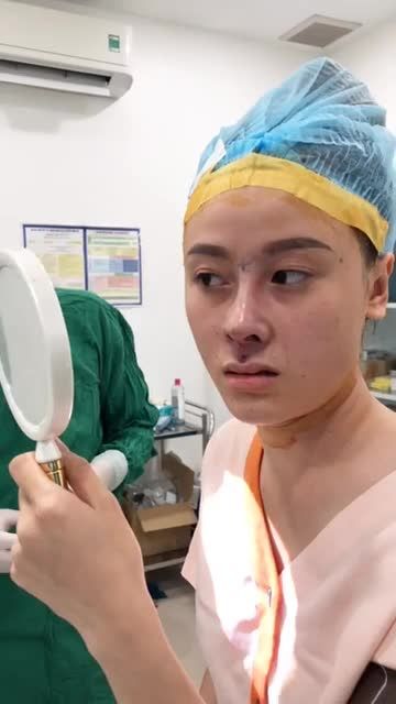 Mũi cấu trúc Surgiform cho khách hàng da mũi mỏng