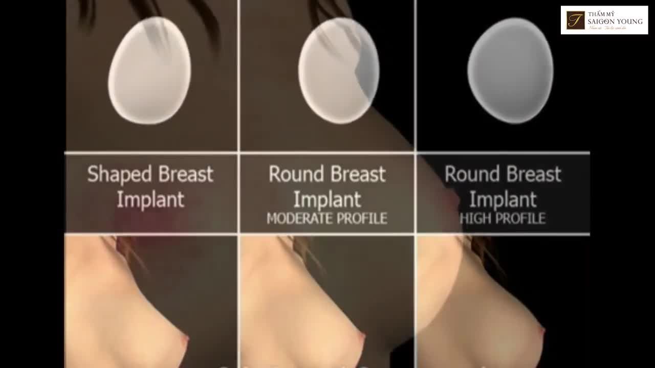 Nâng V1 đường chân ngực là như thế nào?