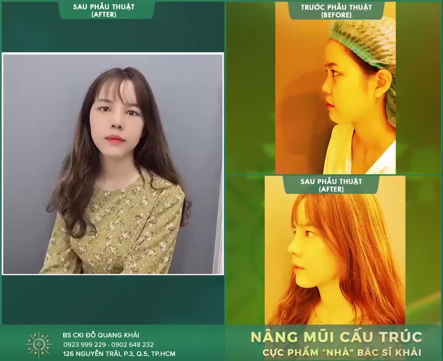 Thêm một ca phẫu thuật nâng mũi cấu trúc thành công tại bác sĩ