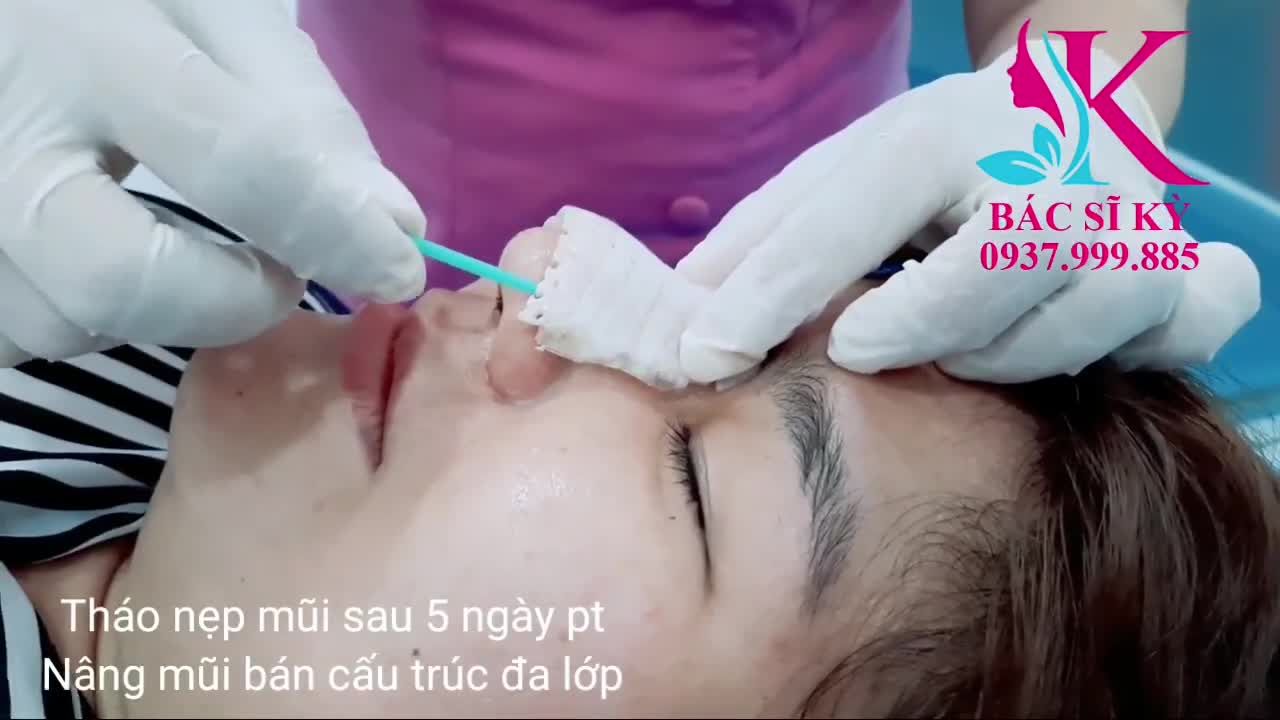 Hướng dẫn tháo nẹp mũ Sau 5 ngày phẫu thuật