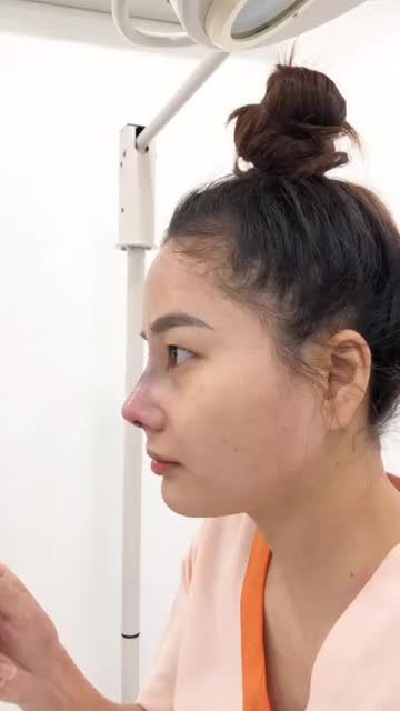 Khi nào nên bọc cân cơ thái dương (fascia) trong nâng mũi?