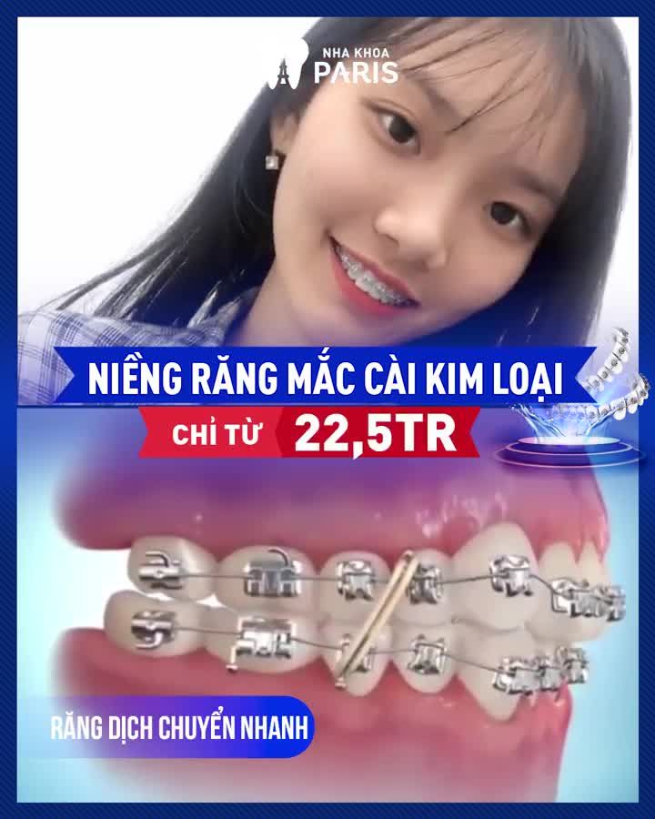 Niềng răng 3D SPEED Ưu đãi CHẠM ĐỈNH 25%