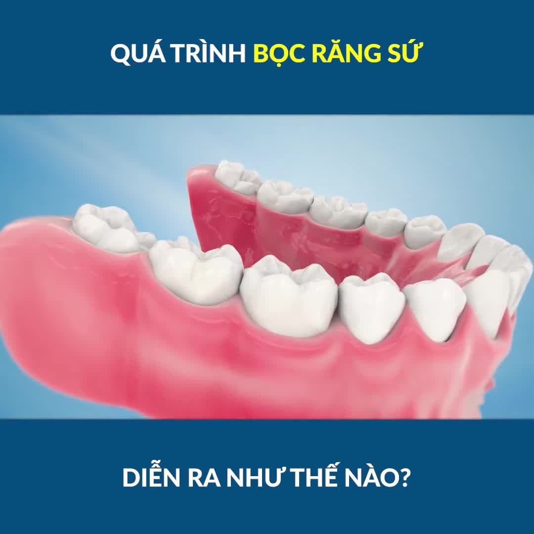 RĂNG ĐƯỢC BỌC SỨ SẼ NHƯ THẾ NÀO?