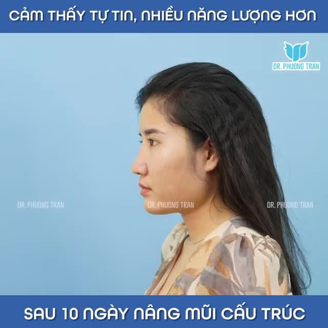 TỰ TIN HƠN, NĂNG LƯỢNG HƠN SAU 10 NGÀY NÂNG MŨI CẤU TRÚC SURGIFORM