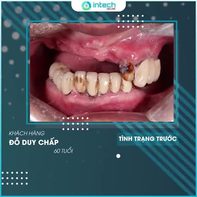 TRỒNG RĂNG IMPLANT CHÚ ĂN NHAI NGON MIỆNG VÀ TỰ TIN HƠN