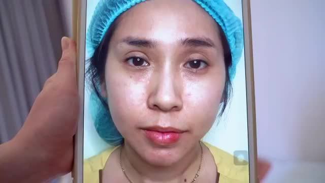 Chỉnh hình mí lỗi hỏng giải cứu thành công đôi mắt biến chứng do thực hiện tại spa kém chất lượng