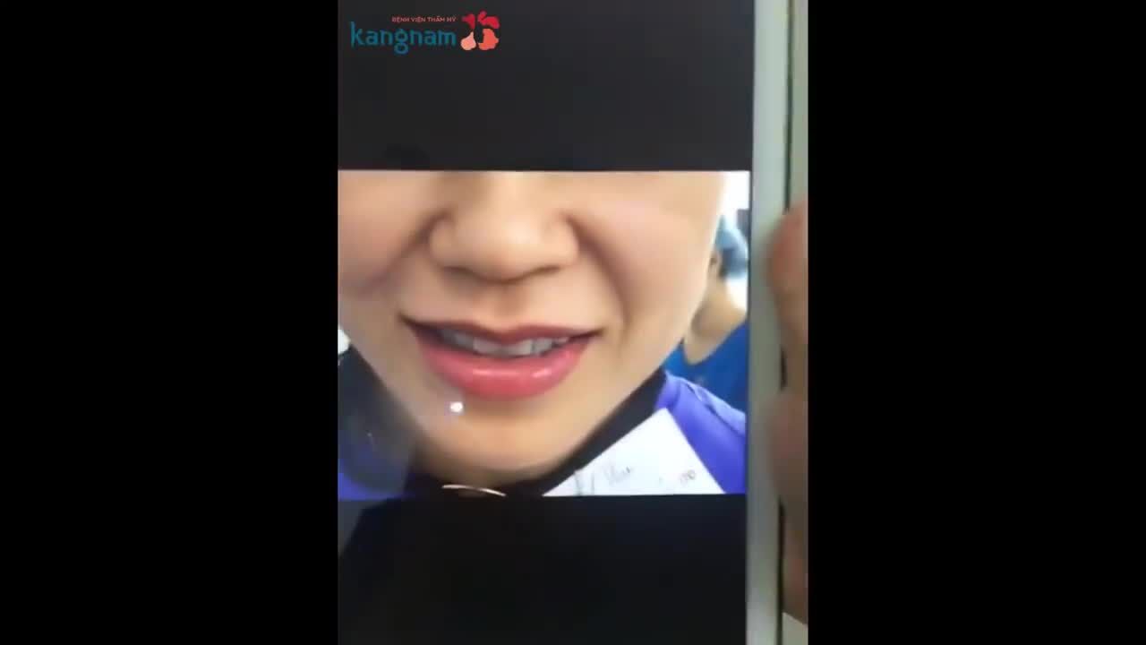 CẤY MỠ NANOFAT XÓA RÂU RỒNG TRẺ HÓA TỨC THÌ