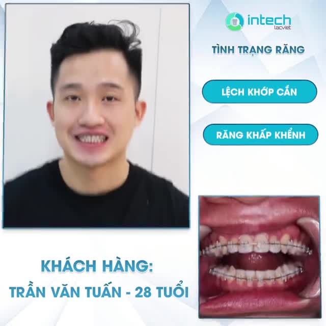 RĂNG KHẤP KHỂNH, LỆCH KHỚP CẮN VÀ HÀNH TRÌNH THAY ĐỔI CỦA CHÀNG TRAI 28 TUỔI