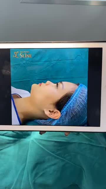 TRẦM TRỒ VỚI KẾT QUẢ CA MŨI CẤU TRÚC SOFTXIL