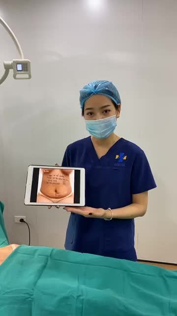 Hút mỡ bụng miễn phí 1 vùng khi khách hàng đăng ký nâng cấp vòng 1 với ekip Sline.