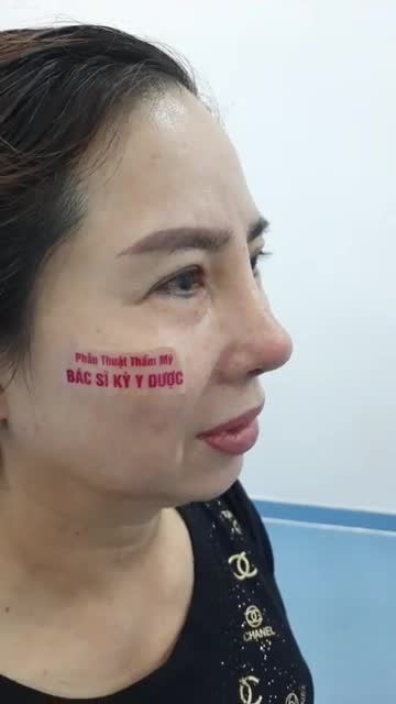 Nâng mũi cấu trúc 2 lớp Dáng mũi thanh tú sau 14 ngày pt