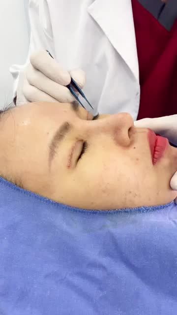 Quy trình cắt mí tại BVTM KANGNAM  mí đẹp chuẩn hàn quốc sau 5 ngày phẫu thuật