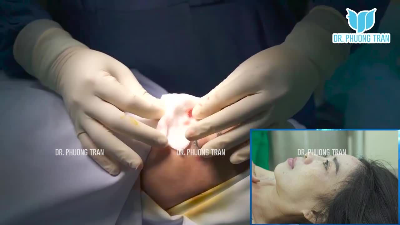 Kết thúc ca nâng mũi sụn sườn cuối ngày