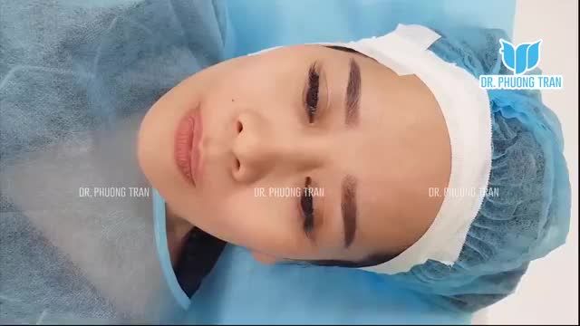 BÁC SĨ THỰC HIỆN COMBO NÂNG MŨI CẤU TRÚC CẤY MỠ MÁ