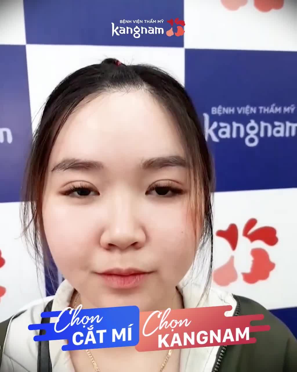 Cắt mí xong Chụp vội một góc cũng thấy ĐẸP