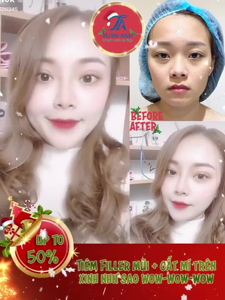 Duy nhất với 1CC Filler JUVEDERM sau 5’ xinh cân đối tuyệt vời, đời đâu còn gì tiếc nuối.