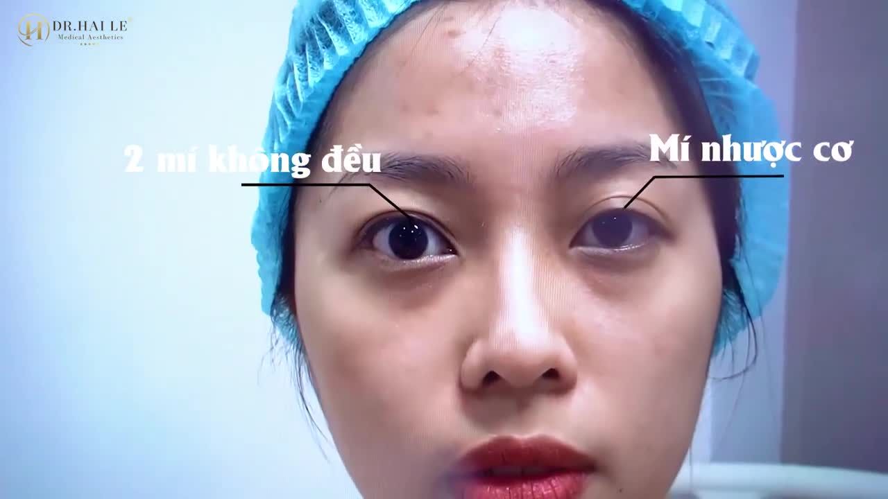 Mắt nhược cơ bẩm sinh có khắc phục được không?